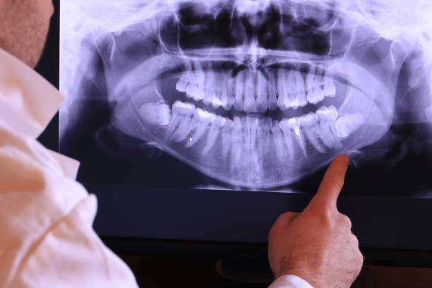Best Emergency Tooth Extraction in Martinez, CA