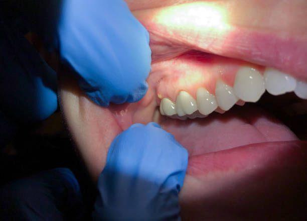 Best Emergency Wisdom Teeth Removal in Martinez, CA